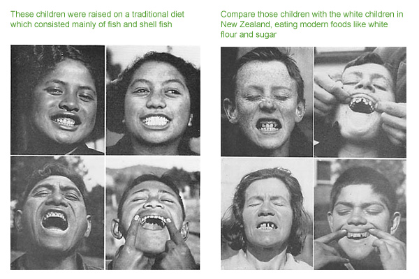 tooth-decay-pictures-photo
